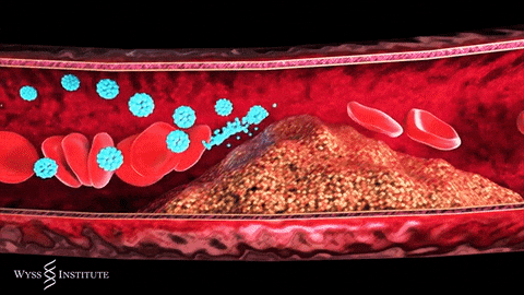 What is a DVT?